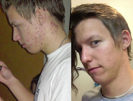 Socker förorsakar acne LCHF bot